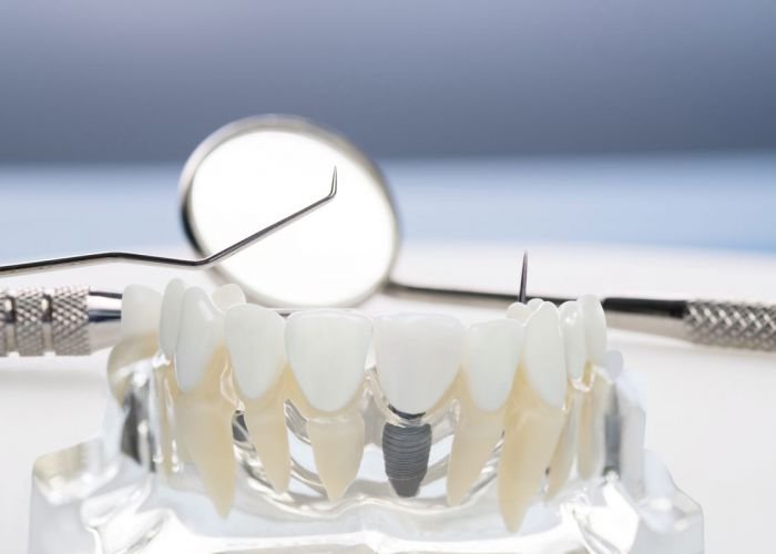Dental model illustrating an implant-supported replacement tooth
