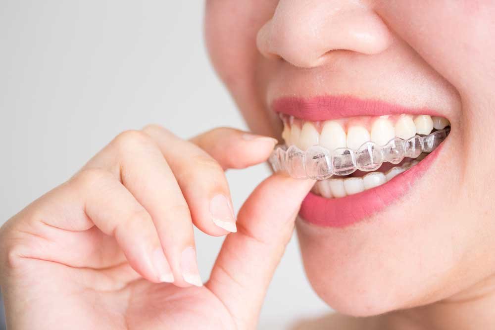 Invisalign® Clear