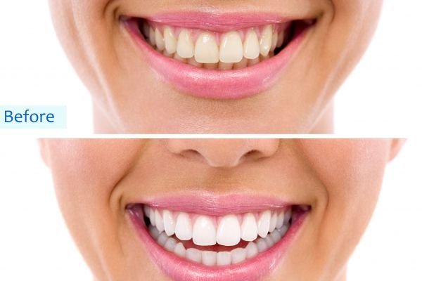 Teeth Whitening