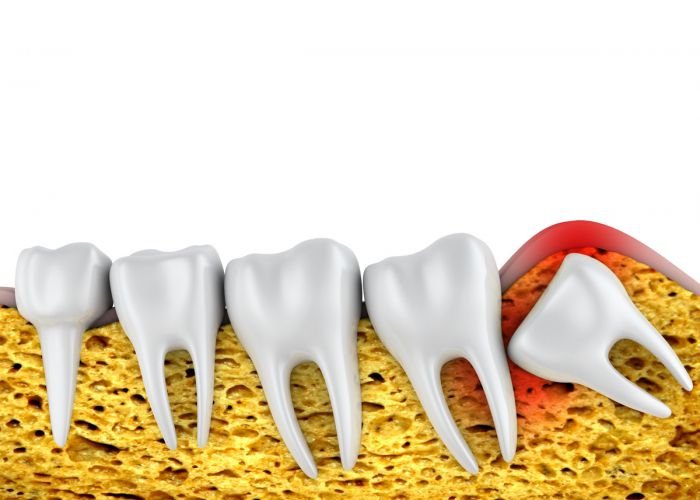 Illustration showing the position of an impacted wisdom tooth